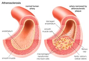 illustration of arteries and atherosclerosis