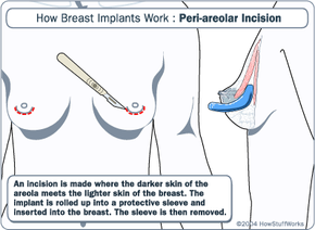 Breast Augmentation Incision Placement