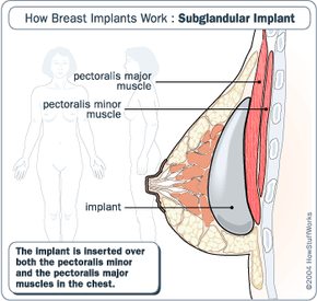 Implant Placement - How Breast Implants Work
