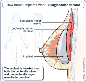 Breast Implants Over The Muscle 