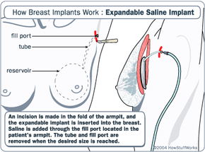 Expandables - How Breast Implants Work