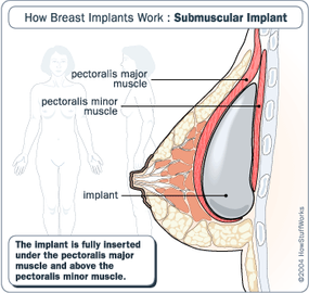 Should I get breast implants under the muscle or over?