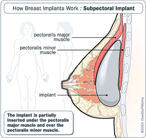 Woman breast implant cross section. Comparison diagram, under and