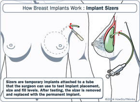 Procedure How Breast Implants Work HowStuffWorks