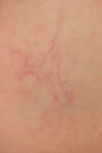 Skin Problems Image Gallery Broken capillaries show up under the skin as reddish lines that don't fade away. See more skin problem pictures