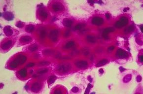 Cancerous cells in a cervix.