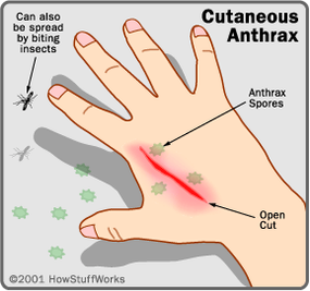 Cutaneous anthrax