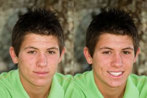 What are some of the side effects associated with acne medication? See more pictures of skin problems.