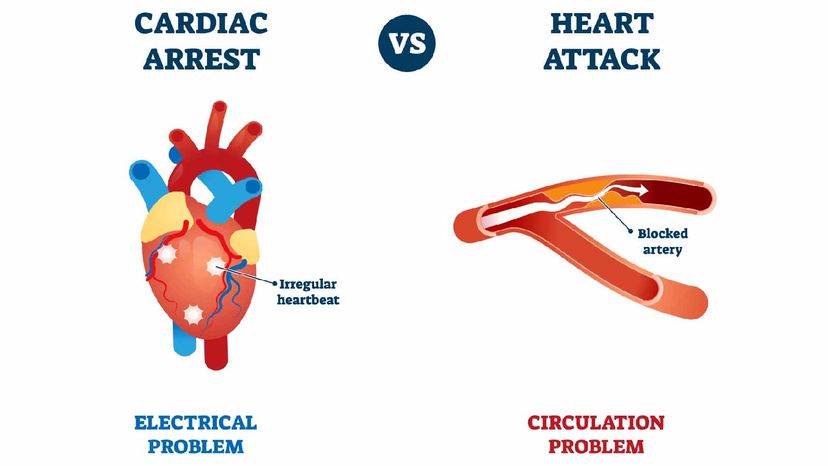 heart attack cardiac arrest