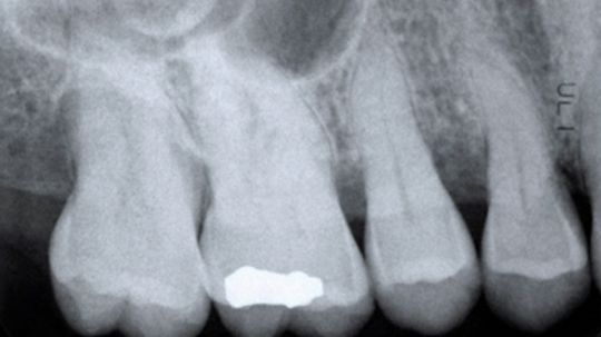 牙齿中的腔如何形成？“border=