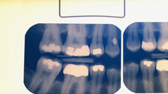 What are the different cavity classifications?