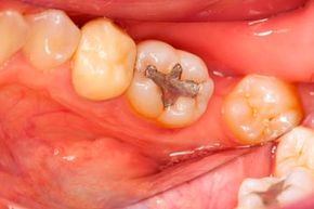 Cavity Filling Howstuffworks