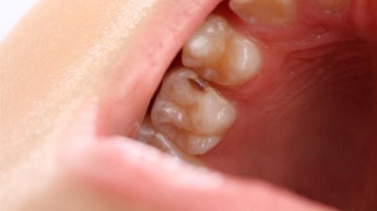 Can you stop a cavity from getting worse?