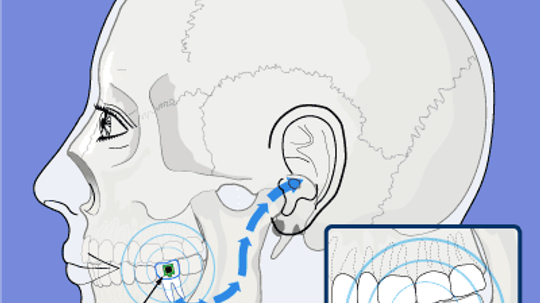 How Cell-phone Implants Work