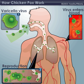 The airborne varicella virus enters the body, then infects the non-immune person.