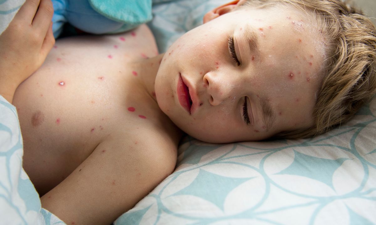 What Is Another Name For Chicken Pox