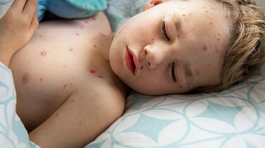 How Chicken Pox Works