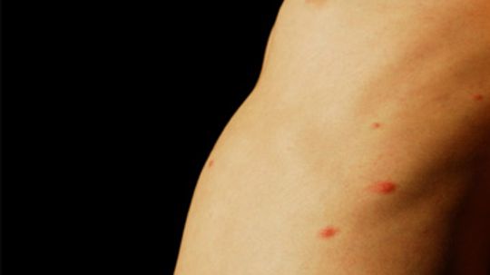 Are chicken pox and shingles the same thing?