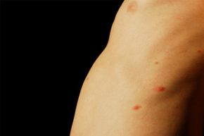 The same virus that causes chickenpox also causes shingles. See more pictures of skin problems.