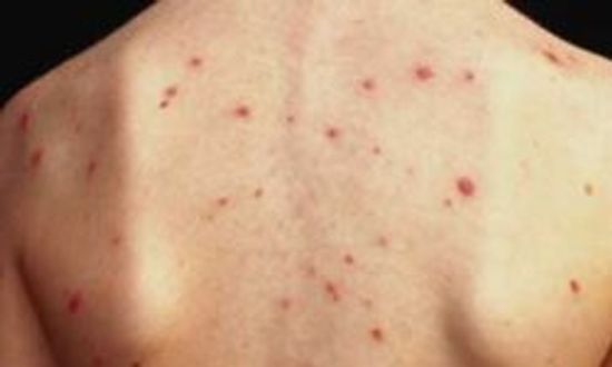 怀孕期间的水痘＂class=