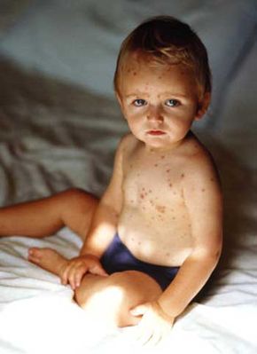 A toddler with chicken pox. Children are most likely to give themselves a secondary bacterial infectionby scratching.