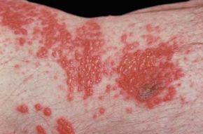 The varicella virus can strike again after chicken pox in the form of shingles.