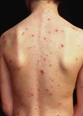That's not a bad case of back acne.It's chicken pox.