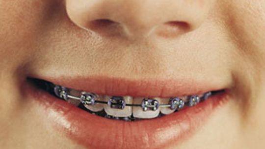 Does your child really need braces?