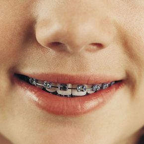 When Do I Get Rubber Bands? - Markham Orthodontics