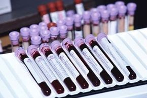 Blood tests are needed to determine how much of your cholesterol is carried by high-density lipoproteins (good) and low-density lipoproteins (bad).