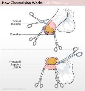 Circumcision Procedure