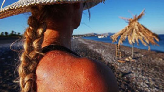 How to Cleanse When You Have a Sunburn