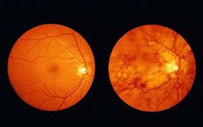 Magnified retina of healthy eye and retina of diabetic eye (mottled)