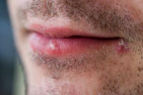 Close-up of man with two cold sores on his lip.