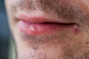 Close-up of man with two cold sores on his lip.