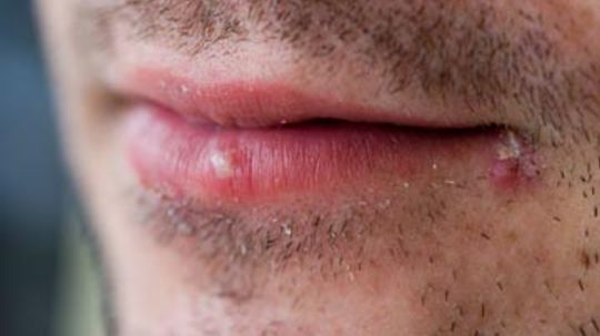 angular cheilitis or cold sore