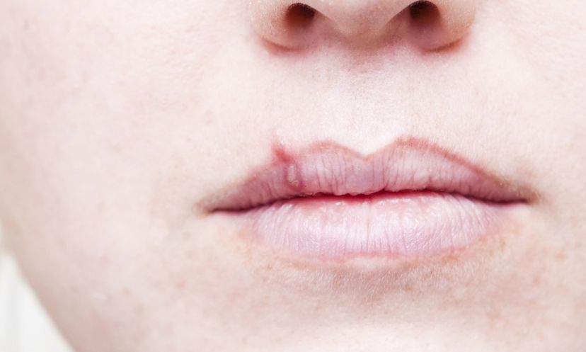 Fact or Fiction: Cold Sores