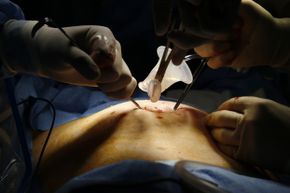 Doctors prepare to make an incision in the belly button of an adult female patient. Hospitals have a few simple methods to reduce patient infections at surgical incisions, and one of them is as straightforward as decreasing the number of people in the room.