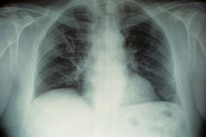 X-ray from a patient's lungs infected with Legionella pneumophila