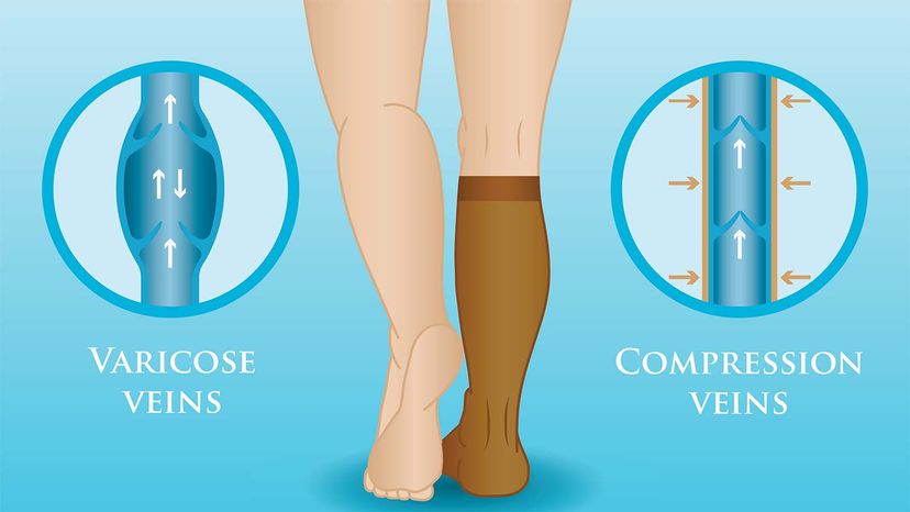 The Importance of Compression Socks/Stockings - Renaissance Foot