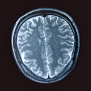 MRI of the brain