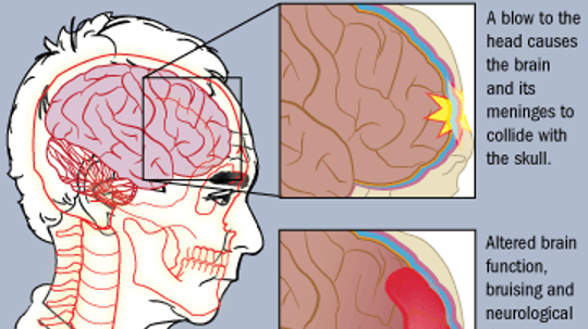 What is a Concussion?