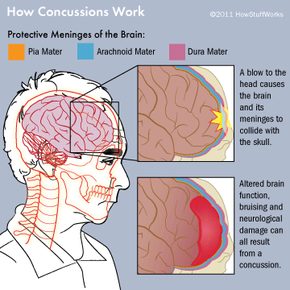 How Concussions Work