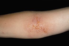 Rash on a human arm caused by contact with Poison Ivy (Toxicodendron (Rhus) radicans). This is a common source of contact dermatitis and allergic reaction caused by the substance toxicodendrol in the plant.