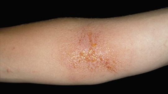 Contact Dermatitis