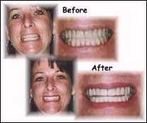 Porcelain veneers in combination with a gum-lift procedure (see below) helped this smile.