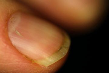 gnarly fingernail