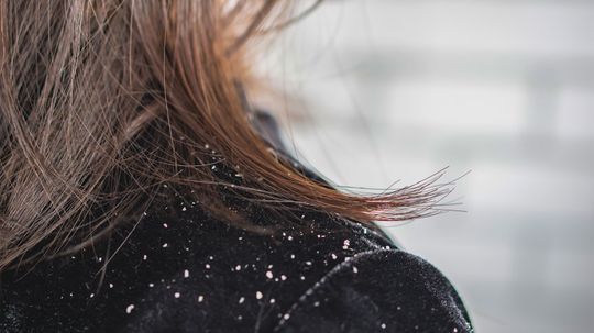 How to Get Rid of Dandruff