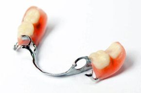 dental bridge