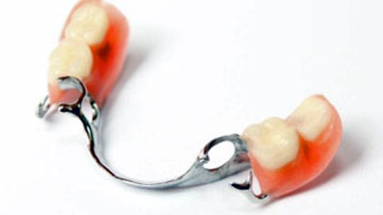 Dental Bridges